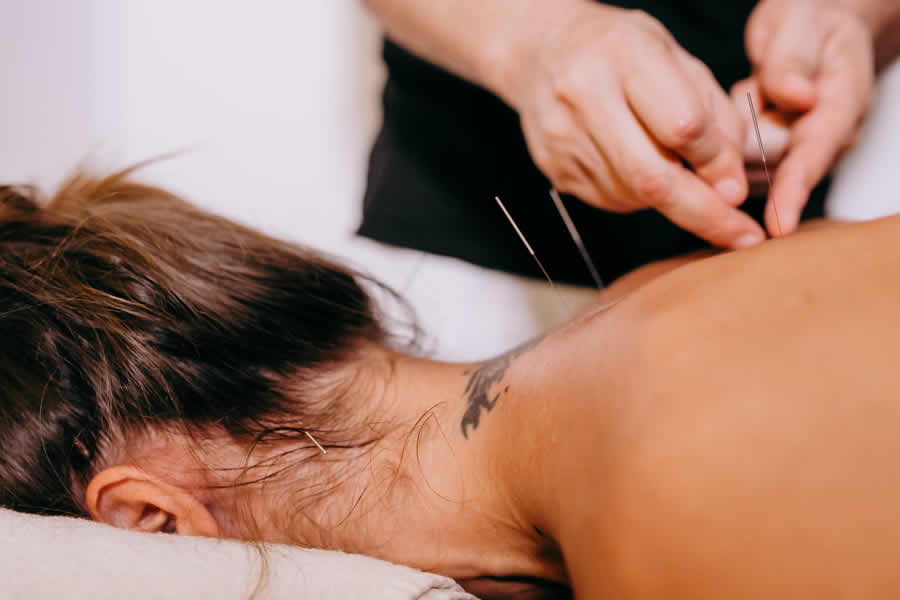 Image of Acupuncture Services