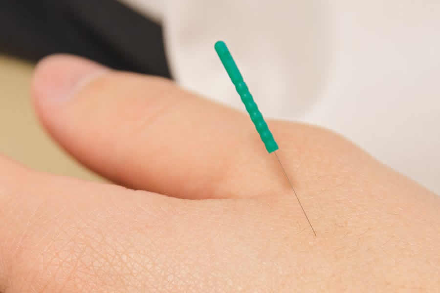 What does an Acupuncturist do